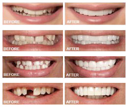 Snap-on Smile – White Plains Family Dental