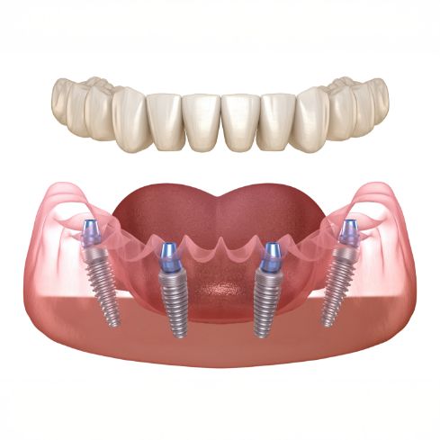 Illustration of a full denture being secured onto four dental implants along an arch