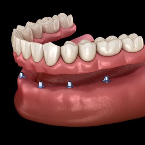 Illustration of an All-on-X implant denture being placed in the lower arch