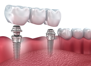 Dental Implants – White Plains Family Dental