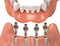 Dentures – White Plains Family Dental