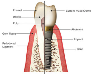 Dental Implants – White Plains Family Dental