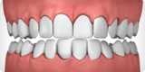 Invisalign® – White Plains Family Dental