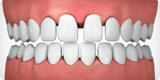 Invisalign® – White Plains Family Dental